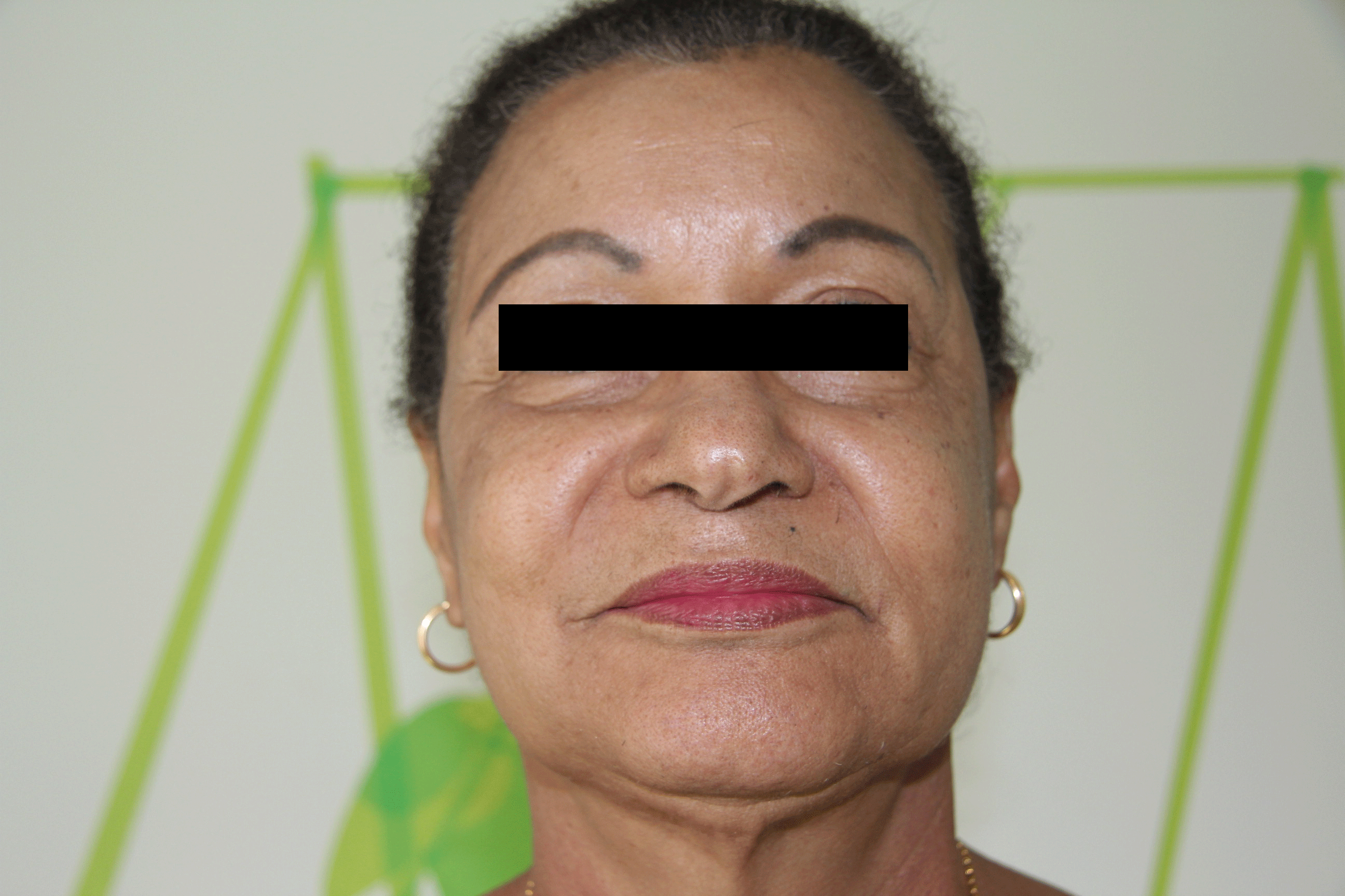 After-Cervico facial